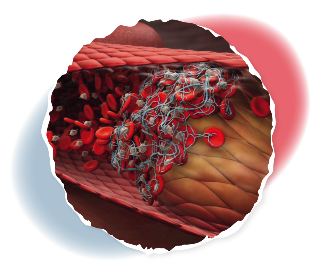 Thrombosen Grafik eines Blutgefäßes, in dem Blutplättchen und rote Blutkörperchen verklumpen und eine Thrombose bilden.